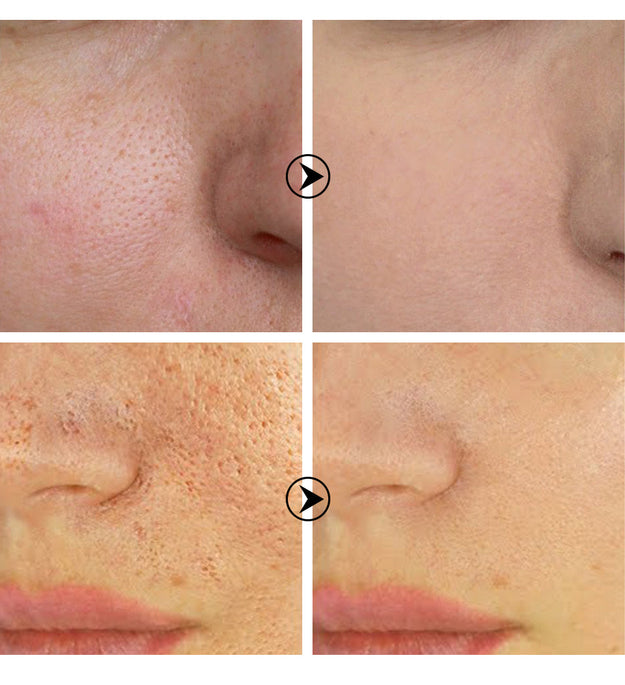 Tea tree pore shrinking serum