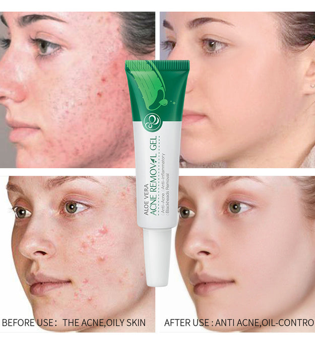 Aloe Acne Treatment Gel Face Cream Serum Anti Acne Scar Cream Shrink Pores Moisturizing Oil Control Soothing Skin Care