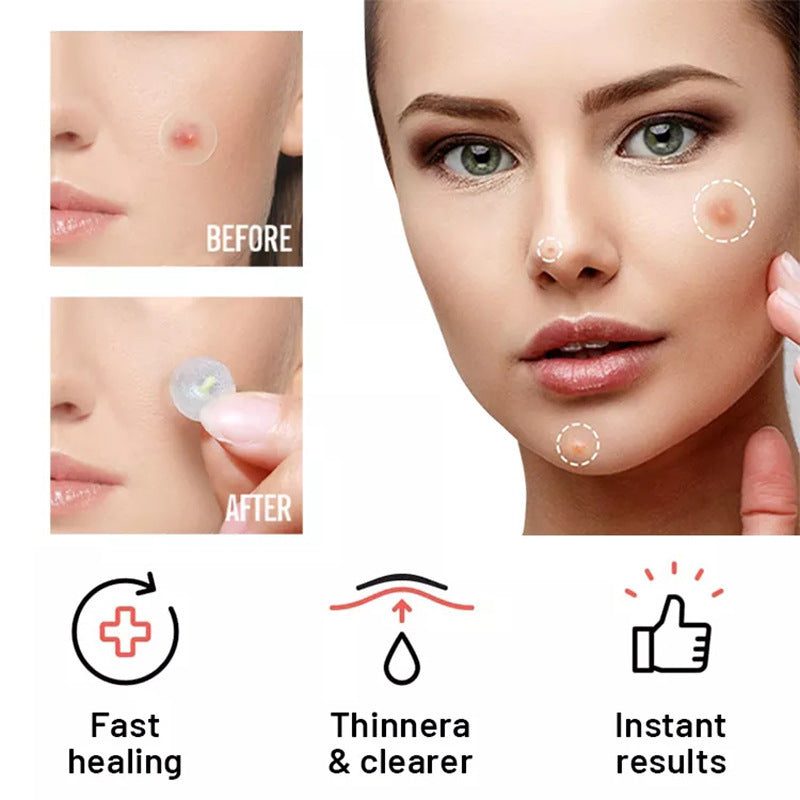 Chin Acne Day And Night Use Repair Acne Patch