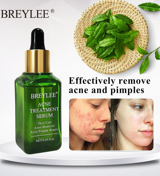 BREYLEE Acne Treatment Serum Face Facial Anti Acne Scar Removal Cream Skin Care Whitening Repair Pimple Remover For Acne