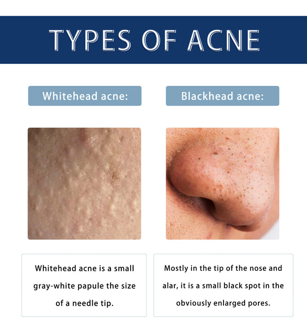 Fade Acne Cream Facial Cleaning And Repair Smallpox Diluting