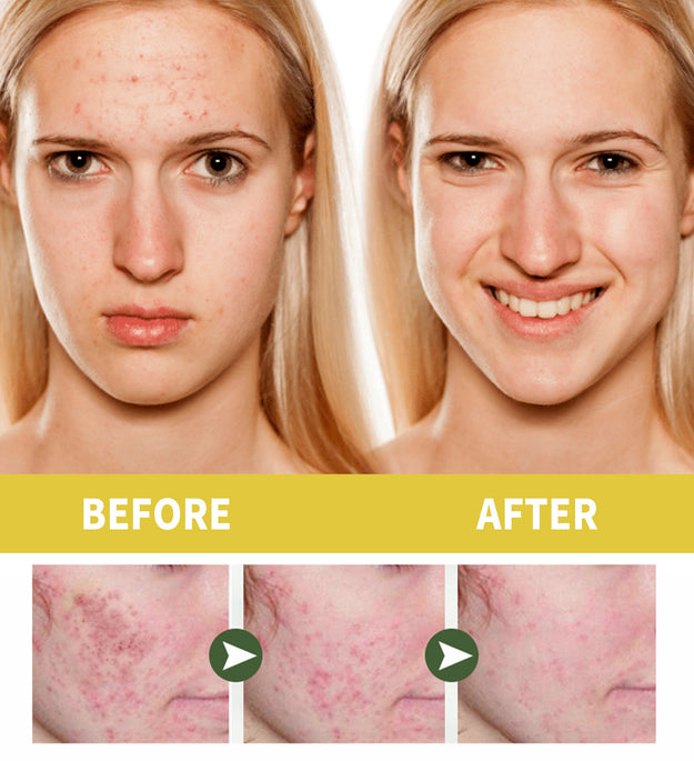 Orchid Acne Treatment Oil Cleansing And Brightening