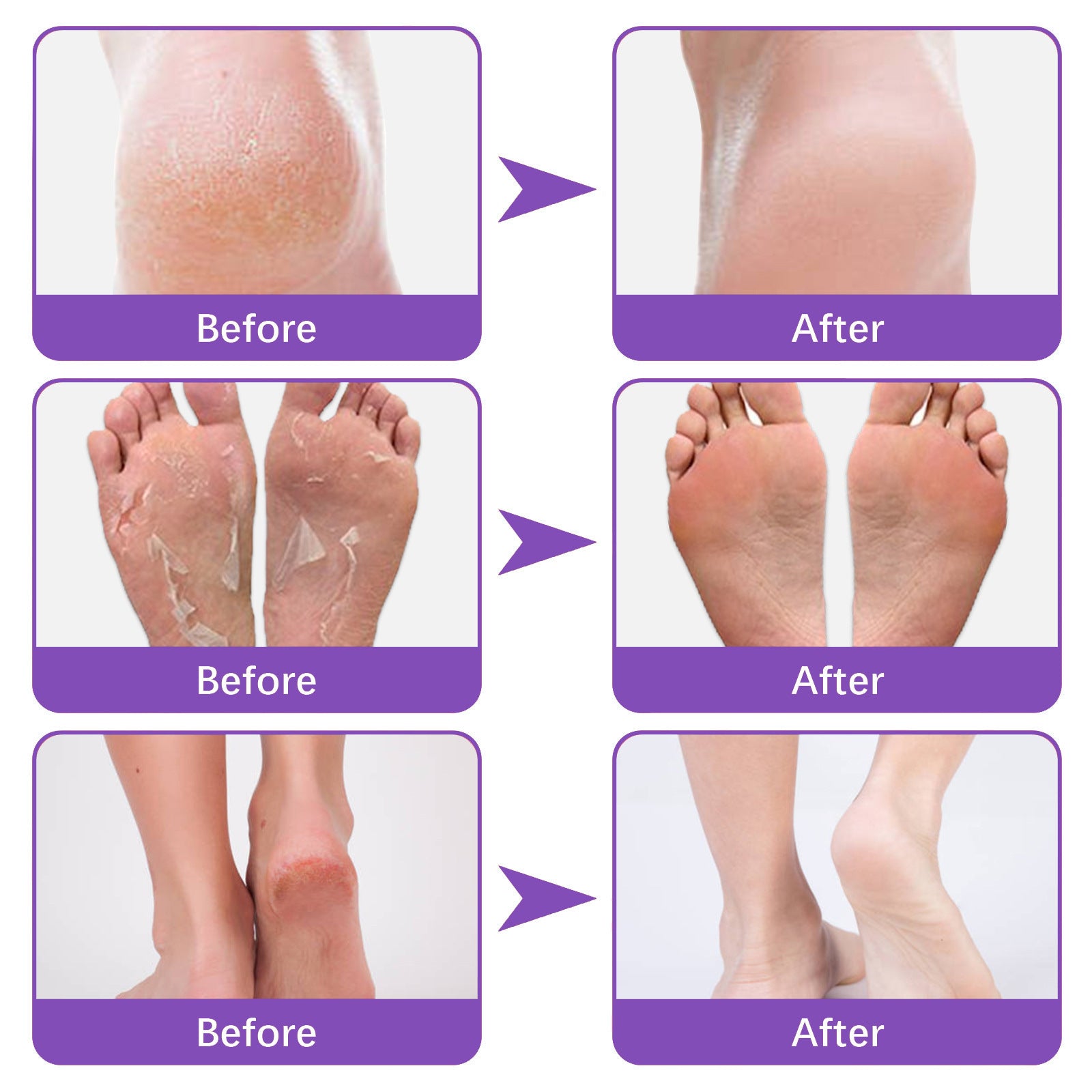 Foot Skin Chapped Exfoliating Exfoliating Exfoliating Skin Moisturizing And Nourishing Foot Mask