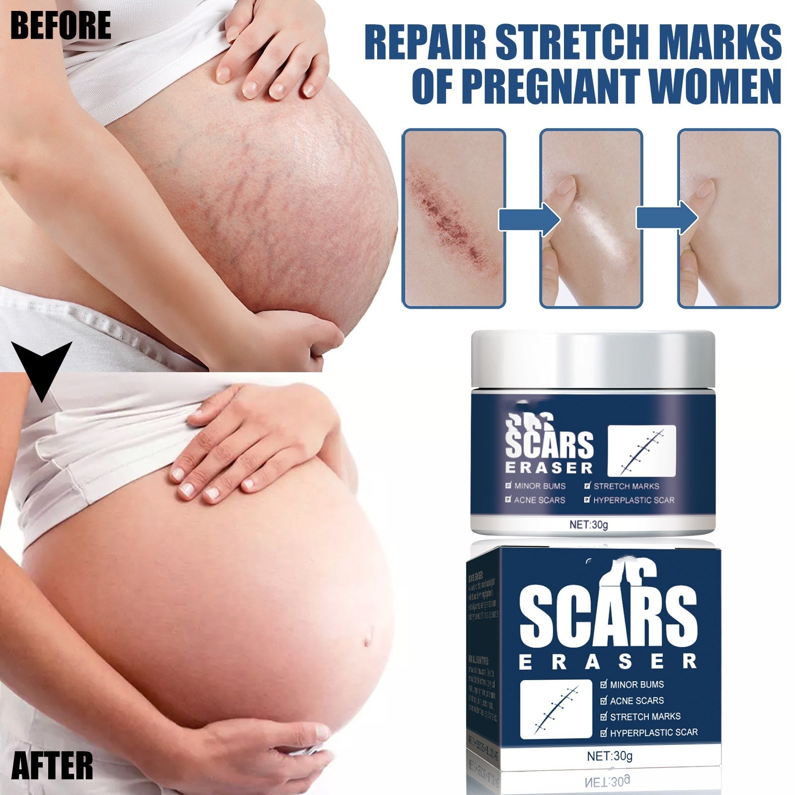Dilute Scar Cream Cold Compress Burn And Scald Marks Dilute Surgical Scar Repair