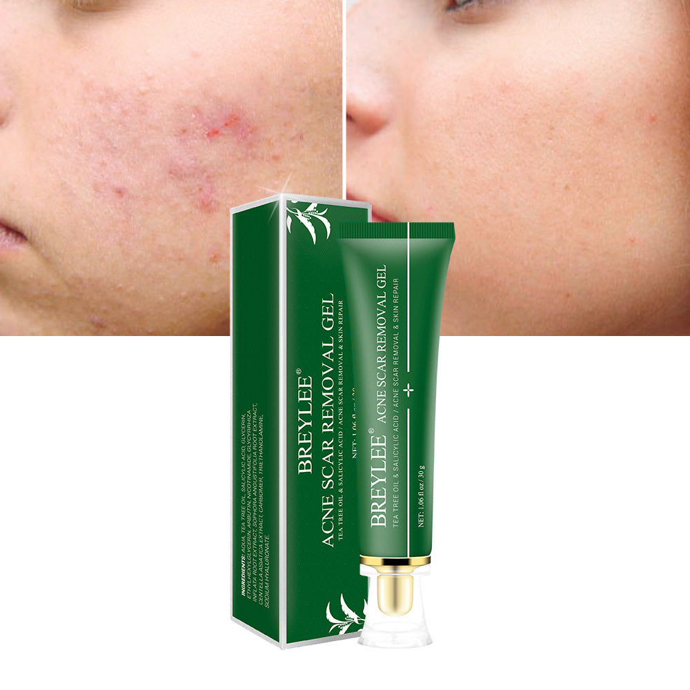 Acne scar removal gel with before and after results showing clear skin improvement on cheeks