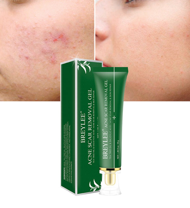 Acne scar removal gel with before and after results showing clear skin improvement on cheeks