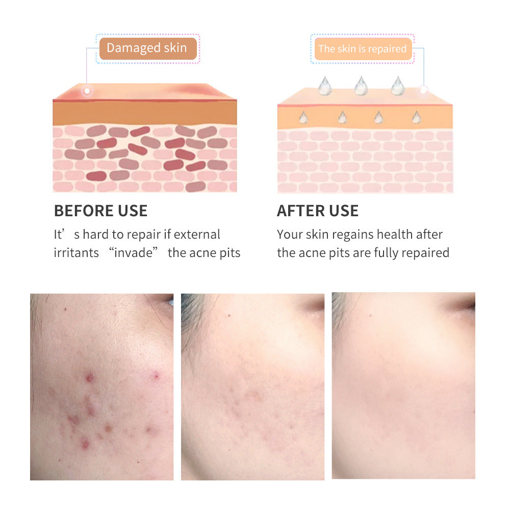 Before and after use of acne scar removal gel showing damaged skin with acne scars and smooth repaired skin