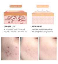 Before and after use of acne scar removal gel showing damaged skin with acne scars and smooth repaired skin