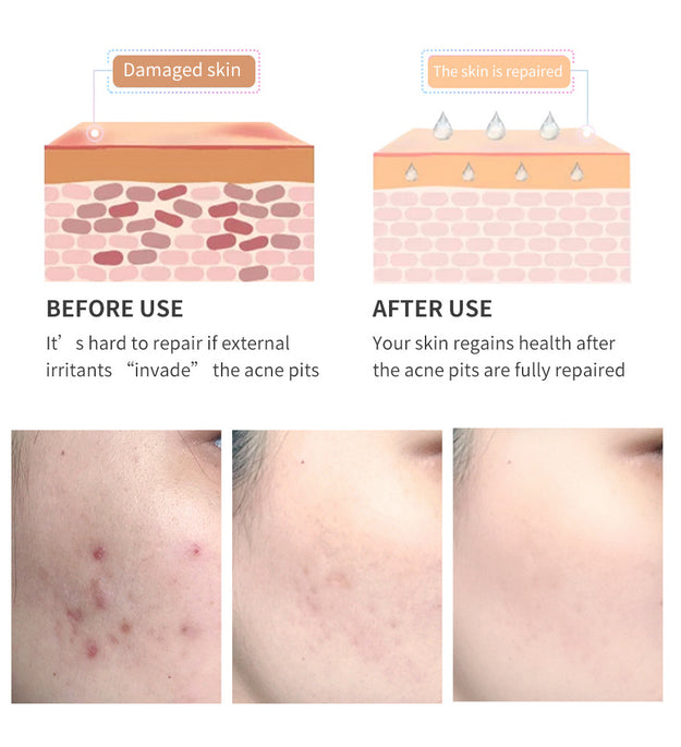 Acne scar removal gel with before and after results showing clear skin improvement on cheeks