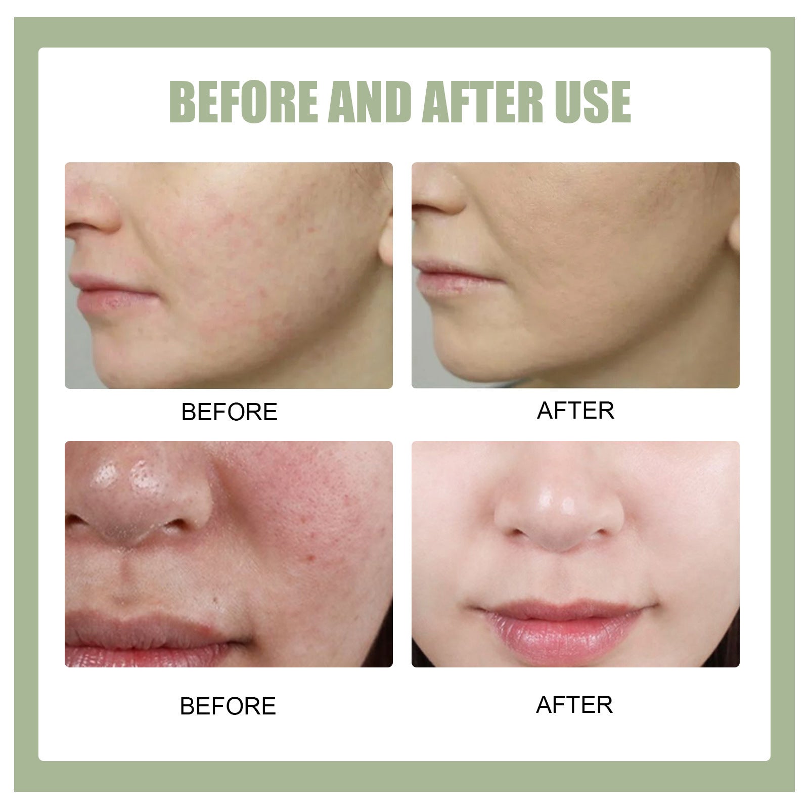 Blemish Gel Modifies Spot Acne Print Cover