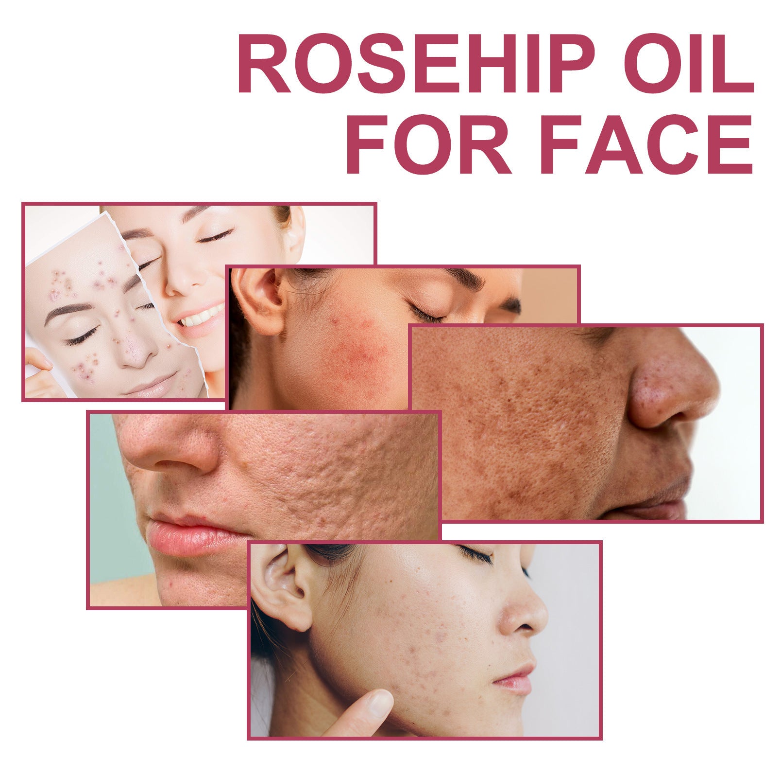 Rosehip Treatment Oil Gently Moisturizes Skin