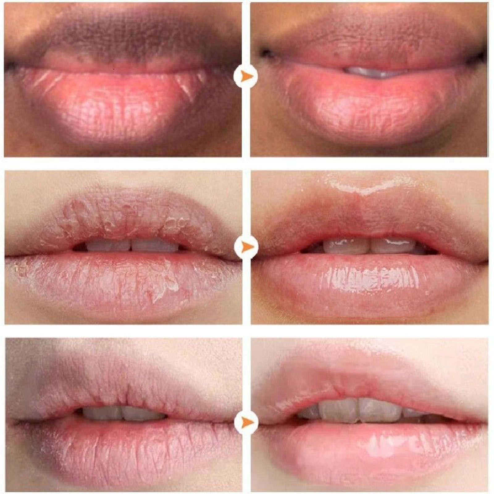 Before and after images showing lips improved from dry and cracked to smooth and hydrated using lip treatment